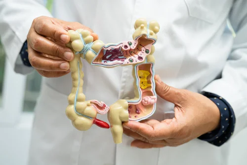 Dietary Changes for Managing Diverticulitis or Diverticulosis