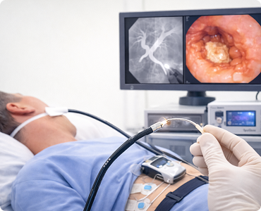 ERCP with SpyGlass